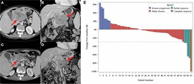 Competing Risk Analysis of Outcomes of Unresectable Pancreatic Cancer Patients Undergoing Definitive Radiotherapy